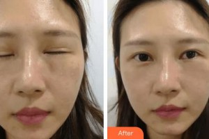 滄州眼科醫(yī)院李月芝整形價格表附眼部綜合案例展示