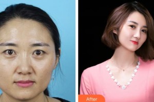 滄州眼科醫(yī)院周暢達(dá)整形價(jià)格表附切開(kāi)雙眼皮案例展示