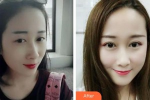 滄州眼科醫(yī)院韓二杰整形價(jià)格表附切開(kāi)雙眼皮案例展示