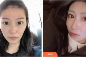 滄州眼科醫(yī)院秦劍英整形價格表附切開雙眼皮案例展示