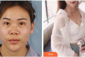 滄州眼科醫(yī)院張立友整形價格表附定點(diǎn)雙眼皮案例展示