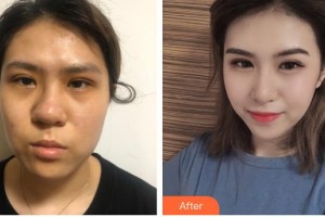 廊坊頤美佳醫(yī)療美容醫(yī)院楊明勇整形價(jià)格表附切開(kāi)雙眼皮案例展示