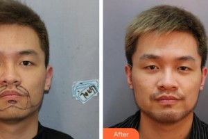 廊坊榮霞醫(yī)療美容診所代金榮整形價(jià)格表附種植胡須案例展示