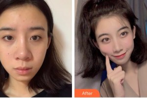 廊坊頤美佳醫(yī)療美容醫(yī)院范金財(cái)整形價格表附鼻部綜合案例展示