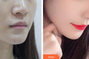 廊坊韓譽(yù)國都醫(yī)療美容診所石承瓚整形價格表附埋線提升案例展示