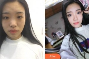 廊坊頤美佳醫(yī)療美容醫(yī)院楊欣整形價格表附硅膠隆鼻案例展示