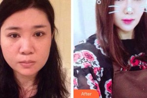 廊坊瑞美慧醫(yī)療美容診所余班林整形價格表附白瓷娃娃案例展示