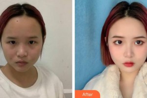 衡水天宏醫(yī)療美容醫(yī)院楊紅曉整形價格表附激光祛斑案例展示