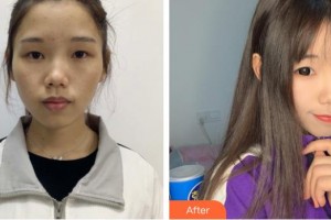 衡水天宏醫(yī)療美容醫(yī)院張浩整形價格表附激光祛斑案例展示