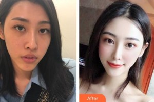 衡水唯美醫(yī)療美容門診部趙燕整形價格表附鼻部綜合案例展示