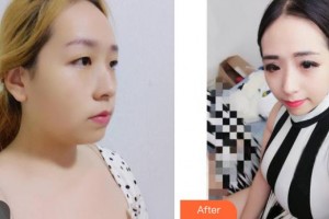 衡水天宏醫(yī)療美容醫(yī)院王蒙整形價格表附鼻部綜合案例展示