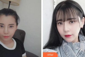 衡水愛爾眼科醫(yī)院陳麗萍整形價格表附眼部綜合案例展示