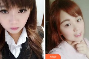 哈爾濱奧康醫(yī)療美容門診部王俊濤整形價格表附牙齒矯正案例展示