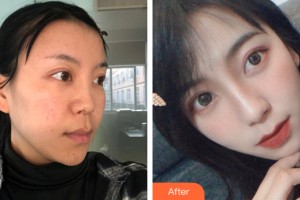 哈爾濱索菲整形美容醫(yī)院陳富全整形價格表附隆鼻手術案例展示