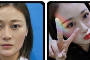 衡水唯美醫(yī)療美容門診部田振宇整形價格表附自體脂肪全臉填充案例展示