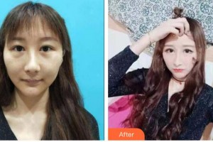 衡水愛爾眼科醫(yī)院劉新苗整形價格表附眼部修復(fù)案例展示