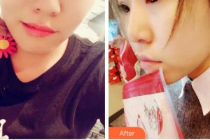 衡水愛爾眼科醫(yī)院楊曉海整形價格表附切開雙眼皮案例展示