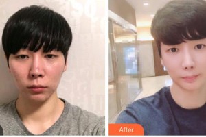 衡水愛爾眼科醫(yī)院賈艷青整形價格表附眼部修復(fù)案例展示