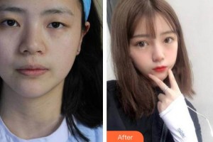 衡水愛爾眼科醫(yī)院趙勇整形價格表附切開雙眼皮案例展示