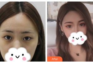 衡水顏美醫(yī)療美容診所馬建華整形價格表附眼部綜合案例展示