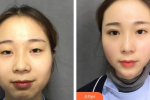 山西武警總醫(yī)院醫(yī)學(xué)整形美容中心季官學(xué)整形價(jià)格表附眼部綜合案例展示