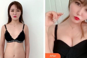 山西醫(yī)科大學(xué)附屬第一醫(yī)院激光整形美容中心王秀延整形價(jià)格表附自體脂肪隆胸案例展示