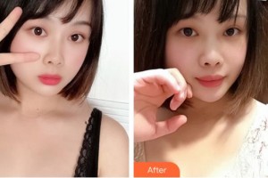 山西立仁激光整形醫(yī)院郭曉蓉整形價(jià)格表附自體脂肪隆胸案例展示