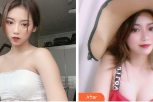 山西立仁激光整形醫(yī)院趙曉萌整形價(jià)格表附自體脂肪隆胸案例展示