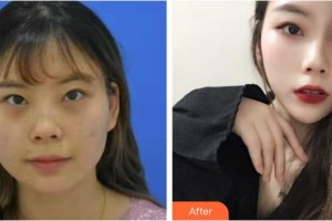 山西伊特雅整形美容門(mén)診部凌霄志整形價(jià)格表附E光嫩膚案例展示