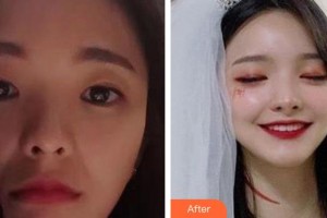 山西伊特雅整形美容門(mén)診部張輝整形價(jià)格表附去痘印痘坑例展示