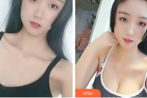 山西武警總醫(yī)院醫(yī)學(xué)整形美容中心張冀滿整形價(jià)格表附自體脂肪隆胸案例展示