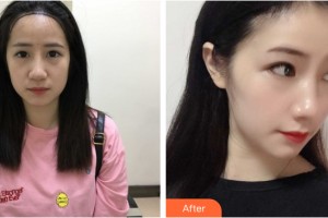 哈爾濱麗珍醫(yī)療美容醫(yī)院辛栄根整形價(jià)格表附植發(fā)案例展示