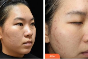 山西醫(yī)科大學(xué)附屬太鋼總醫(yī)院燒傷整形中心郝文杰整形價(jià)格表附清潔祛痘案例展示