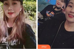 山西立仁激光整形醫(yī)院王姝整形價(jià)格表附去痘印痘坑案例展示