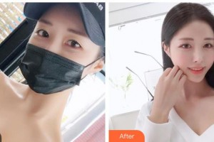 山西省整形外科醫(yī)院王德寧整形價(jià)格表附光子嫩膚案例展示