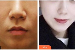 山西省整形外科醫(yī)院陳齊鳴整形價(jià)格表附微針美膚案例展示