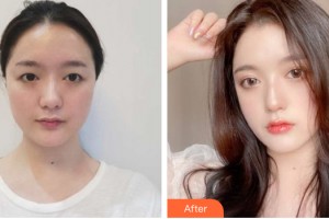 哈爾濱二四二醫(yī)院美容整形科趙英年整形價格表附眼部手術(shù)案例展示