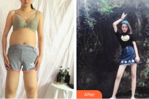 哈爾濱雅美整形美容醫(yī)院姜立山整形價格表附大腿吸脂案例展示