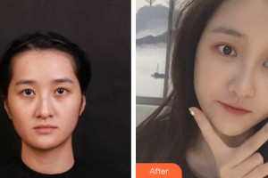 蘭州黛美爾醫(yī)學(xué)美容醫(yī)院任文明整形價(jià)格表附自體脂肪填充案例展示