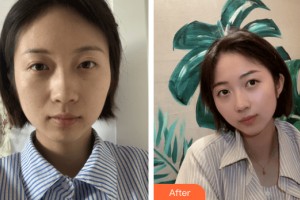 蘭州美月整形美容醫(yī)院于晟整形價格表附皮膚美容案例展示