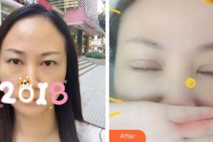 山西省眼科醫(yī)院馮雪亮整形價(jià)格表附切開雙眼皮案例展示