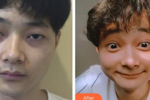 山西省眼科醫(yī)院李俊紅整形價(jià)格表附切開雙眼皮案例展示