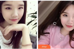 山西省眼科醫(yī)院高小琴整形價(jià)格表附眼部綜合案例展示