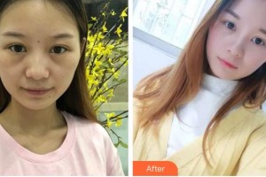 山西省眼科醫(yī)院趙軍梅整形價(jià)格表附激光去眼袋案例展示