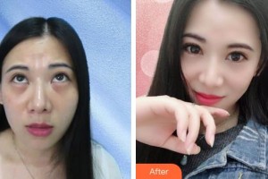 山西省眼科醫(yī)院劉剛整形價(jià)格表附內(nèi)切祛眼袋案例展示