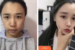 山西省眼科醫(yī)院魏彤心整形價(jià)格表附眼部綜合案例展示