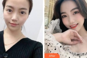 山西省眼科醫(yī)院孔淼整形價(jià)格表附眼部綜合案例展示