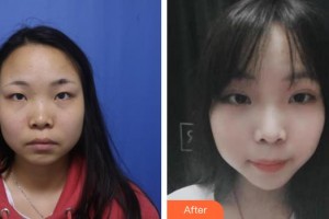 山西省眼科醫(yī)院賀瑞整形價(jià)格表附定點(diǎn)雙眼皮案例展示