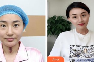 山西省眼科醫(yī)院王曉剛整形價格表附切開雙眼皮案例展示