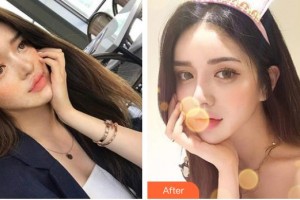 太原華美整形美容醫(yī)院吳強整形價格表附激光去紋身案例展示